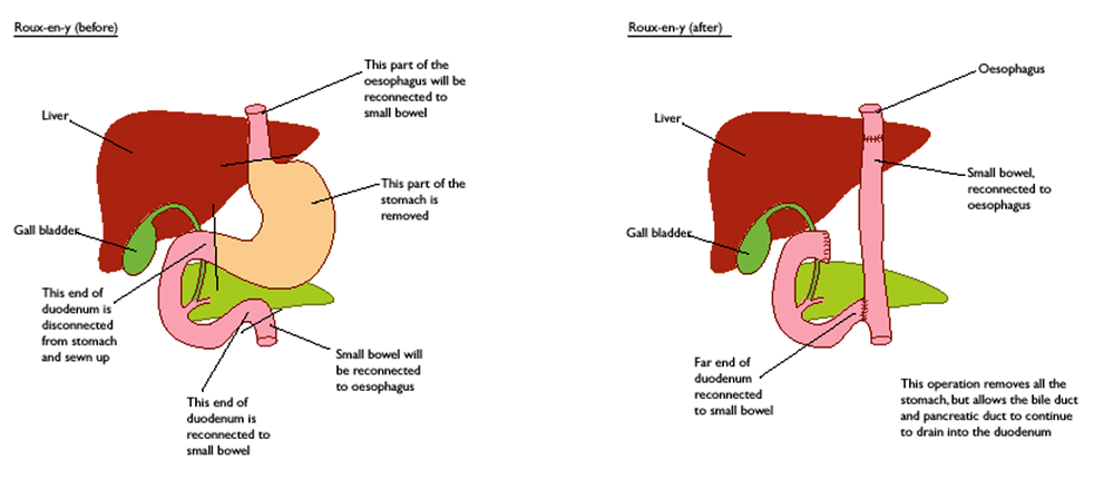 Gastrectomy-Before-and-After